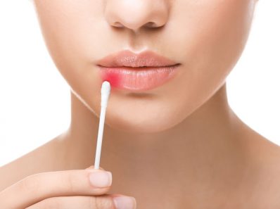 Mujer con herpes labial
